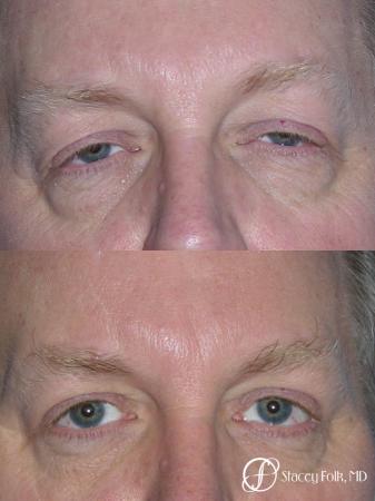 Denver Upper & Lower Blepharoplasty 7158 - Before Image 1