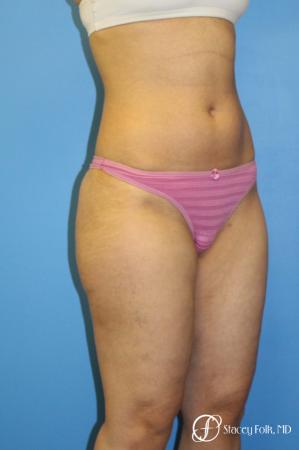 Denver Liposuction 8512 - After Image 2