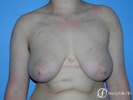 Denver Female to Male Top Surgery 5257 - Before Image 1
