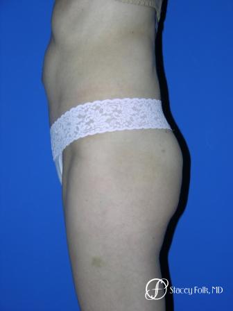 Denver Tummy Tuck 20 - After Image 2