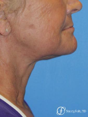 Facelift and Laser - After Image 1