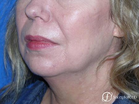 Denver Facial Rejuvenation Facelift, Fat Transfer, and Laser Resurfacing 8513 - Before Image 2