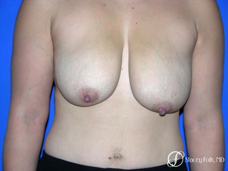 Denver Breast reduction 5842 - Before Image 1