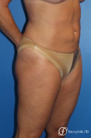 Denver Liposuction 10267 - After Image 3