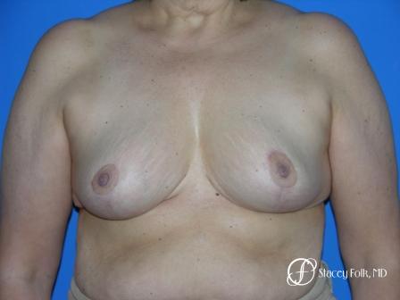 Denver Breast Reduction 55 - After Image 1