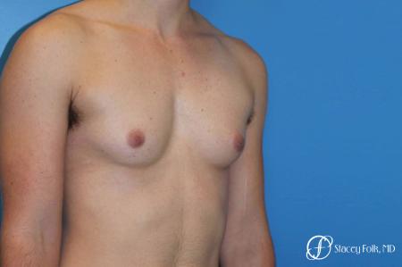 Denver FTM female to male top surgery using gynecomastia technique 5128 - Before Image 2
