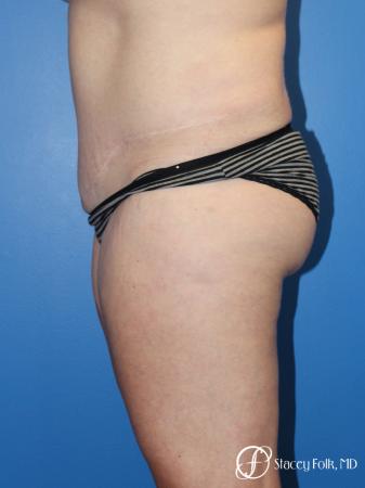 Denver Tummy Tuck (Abdominoplasty) and Liposuction 10381 - After Image 3