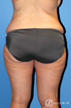 Denver Body Lift belt lipectomy, liposuction, mastopexy 5935 - Before Image 2