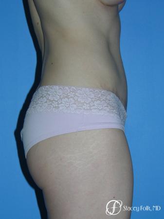 Denver Tummy Tuck - Abdominoplasty 10444 - After Image 3