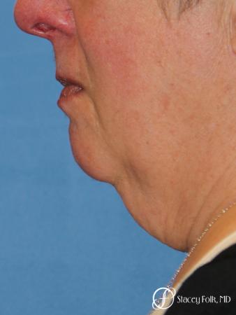 Denver Facial Rejuvenation Face and Neck Lift with Fat Transfer to the Face 9133 - Before Image 1