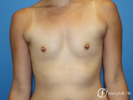 Denver Breast augmentation using textured anatomical implants 5849 - Before Image 1