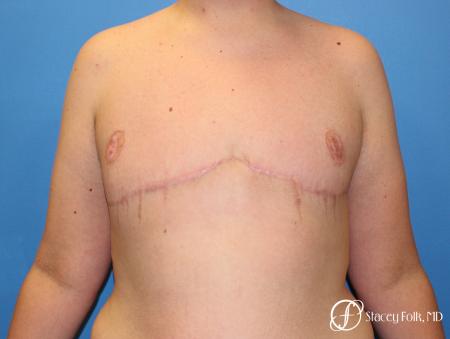 Denver FTM Female to male top surgery 5255 - After Image 1