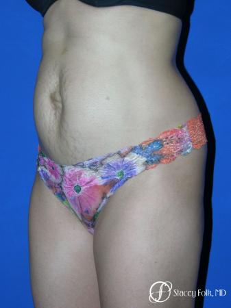 Denver Tummy Tuck Abdominoplasty 5456 - Before Image 2