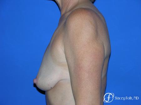 Denver Breast Lift and Augmentation 4557 - Before and After Image 3