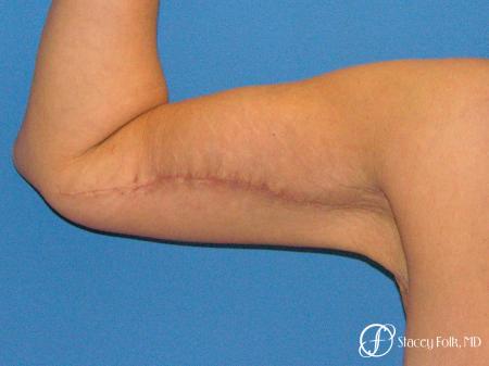 Denver Brachioplasty 8467 - After Image 2