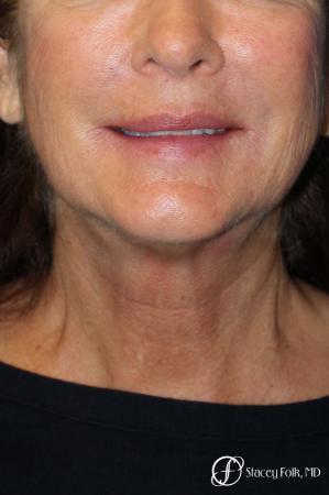 Denver Facelift & Laser Resurfacing 8277 - Before and After Image 3