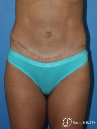 Denver Tummy Tuck - Abdominoplasty 8299 - After Image 1
