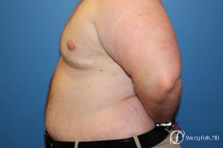 Denver Female to male top surgery 5258 - After Image 2