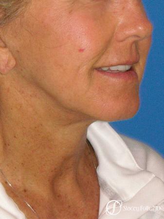 Denver Facial Rejuvenation Face Lift and Laser Resurfacing 7119 - After Image 2