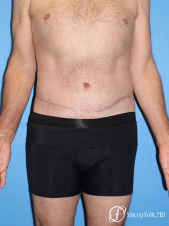 Denver Body Lift - Belt Lipectomy 8570 - After Image 1
