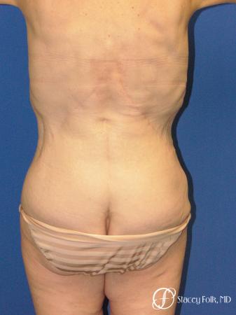 Denver Body Lift 5299 - After Image 2