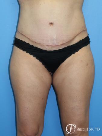 Tummy Tuck (Abdominoplasty) and Liposuction - After Image 1