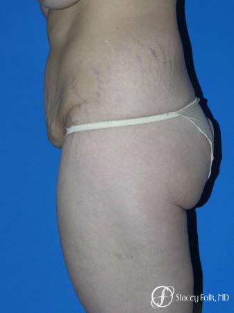 Denver Body Lift Belt lipectomy 5262 - Before and After Image 3