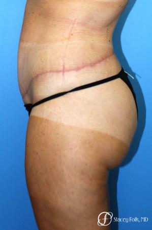 Denver Body Lift belt lipectomy, liposuction, mastopexy 5935 - After Image 3