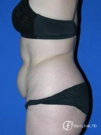 Denver Tummy Tuck 44 - Before and After Image 3