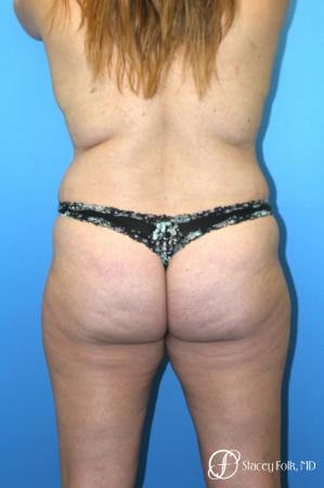 Tummy Tuck (Abdominoplasty) and Liposuction - Before Image 2