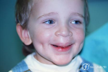 Denver Cleft Lip and Palate Repair 6187 - After 1