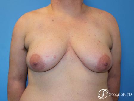 Denver FTM Female to male top surgery 5253 - Before Image 1