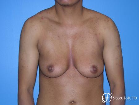 Denver FTM Female to male top surgery 5254 - Before Image 1