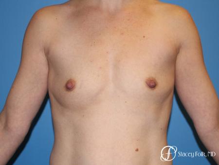 Denver Breast Augmentation using Textured Sientra Breast Implants 8414 - Before Image 1