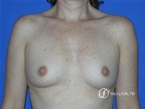 Denver Breast Augmentation 11 - Before Image 1