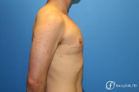 Denver FTM Female to male top surgery 6608 - After Image 2