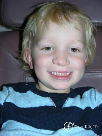 Denver Cleft Lip and Palate Repair 964 - After Image 1