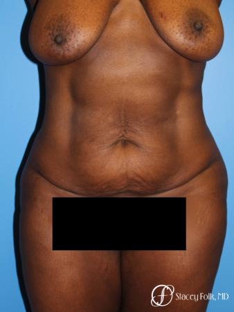 Denver Tummy Tuck - Abdominoplasty 7514 - Before Image 1