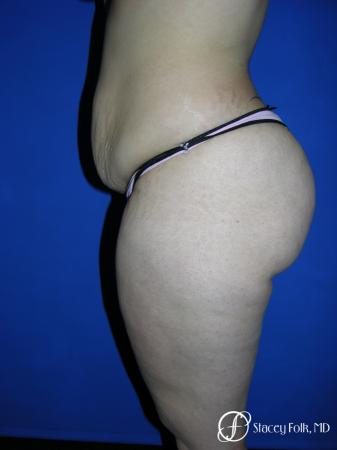 Denver Tummy Tuck 23 - Before and After Image 2