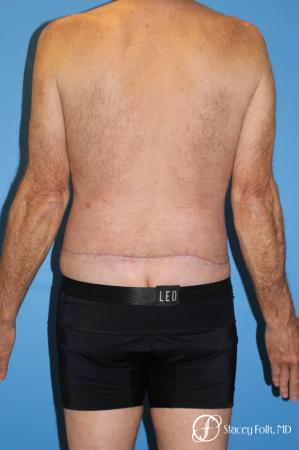 Denver Body Lift - Belt Lipectomy 8570 - After Image 2