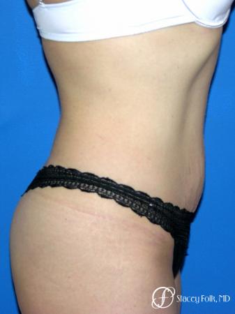Denver Coolsculpting 8160 - After Image 1