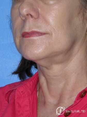 Denver Facial Rejuvenation Face Lift and Fat Injections 7117 - Before Image 2