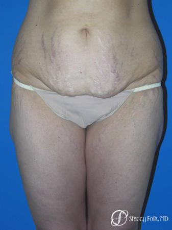 Denver Body Lift Belt lipectomy 5262 - Before Image 1