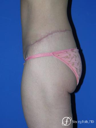 Denver Body Lift Belt lipectomy 5262 - After Image 3