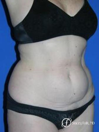 Denver Tummy Tuck 44 - Before Image 2