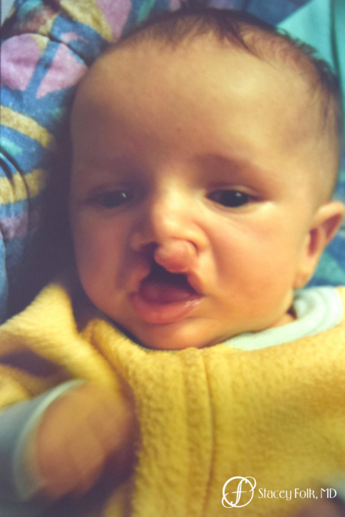 Denver Cleft Lip and Palate Repair 6187 - Before 1