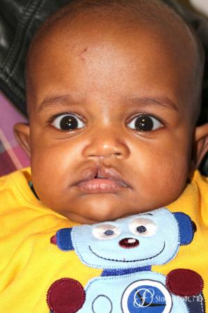 Denver Cleft lip repair 5934 - Before Image 1
