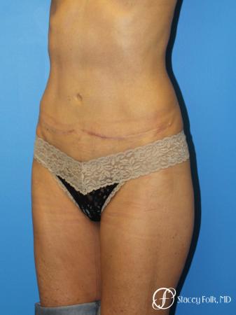Denver Tummy Tuck Abdominoplasty 5609 - After Image 2