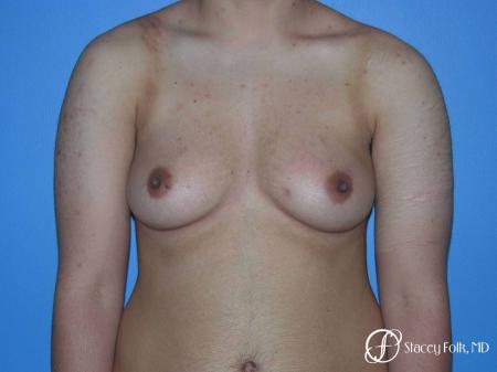 Denver FTM Female to male top surgery 5105 - Before Image 1