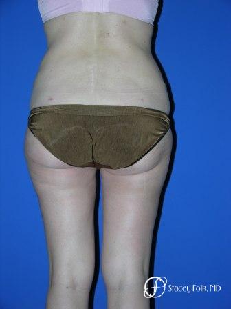 Denver Tummy Tuck 34 - After Image 3